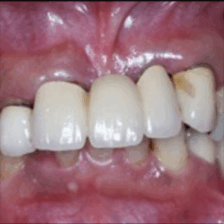 神保町野本歯科医院のセラミック治療症例