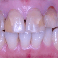 神保町野本歯科医院のセラミック治療症例