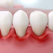 神保町野本歯科医院で神経のない歯(失活歯)が痛い原因と治療法について解説